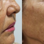 HILOS JAPON CASO 1 A